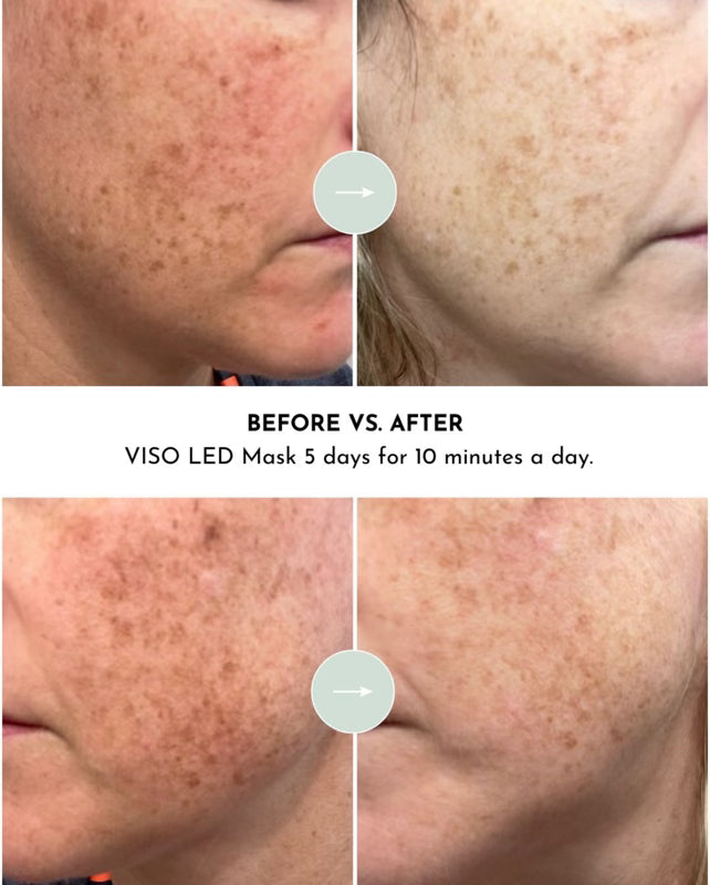 Lumara VISO - FDA Cleared Red Light Therapy Mask - 4 pk